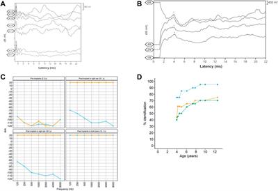 Case report: De novo pathogenic variant in WFS1 causes Wolfram-like syndrome debuting with congenital bilateral deafness